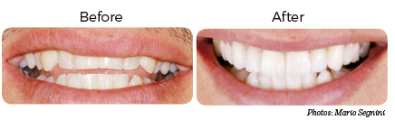 Dental veneers before and after photo dental tourism costa rica