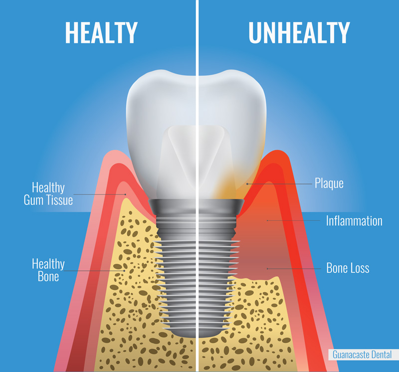 Dental-implant